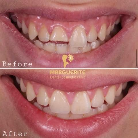 trám răng thẩm mỹ nha khoa Marguerite