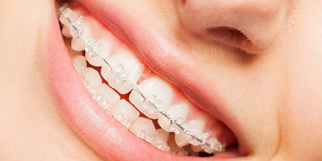 Niềng răng mắc cài sứ tại nha khoa Marguerite