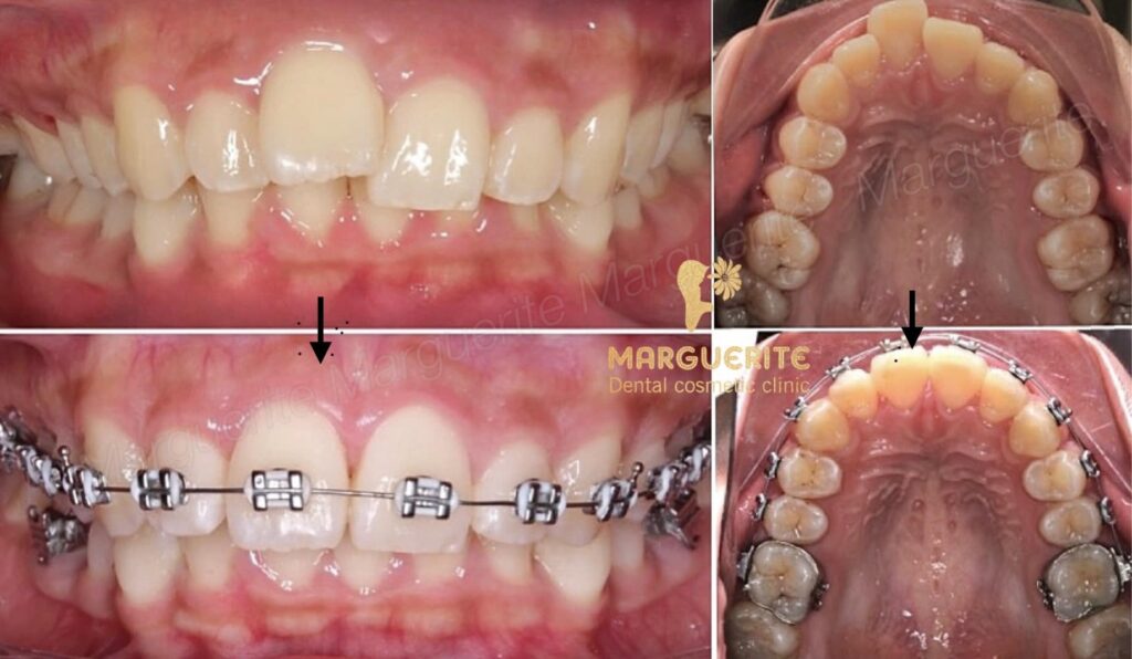 Niềng răng mắc cài truyền thống tại nha khoa Marguerite hiệu quả cao, chi phí hợp lý, giúp răng đều đẹp với quy trình chuẩn, an toàn và theo dõi sát từ bác sĩ chuyên khoa.
