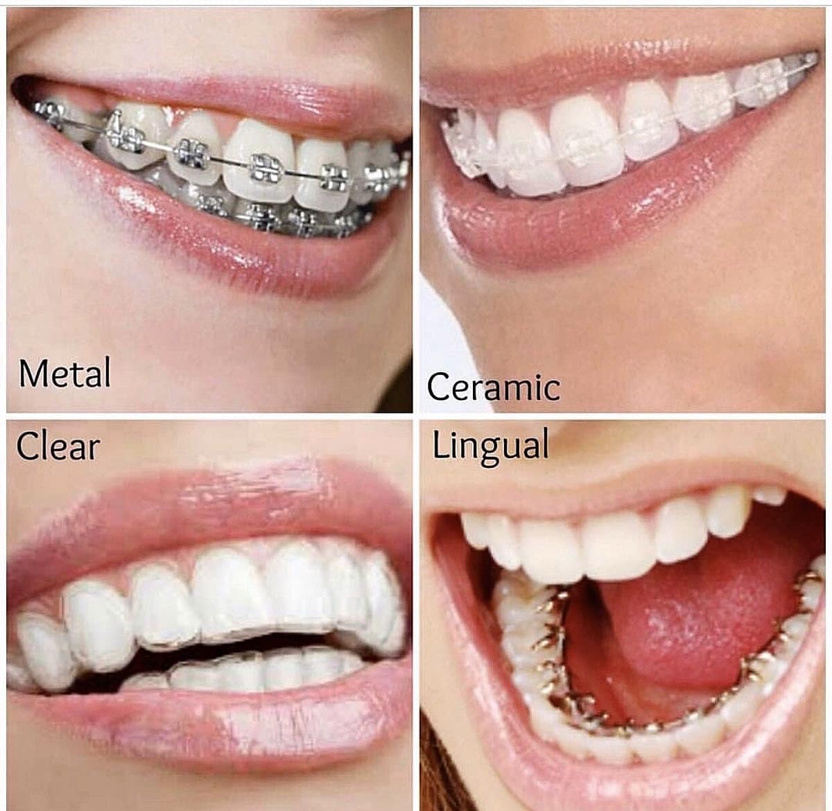 Niềng răng Marguerite - đồng hành cùng nụ cười của bạn
