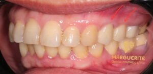 Bọc răng sứ tại nha khoa Marguerite - cam kết cải thiện thẩm mỹ và chức năng ăn nhai