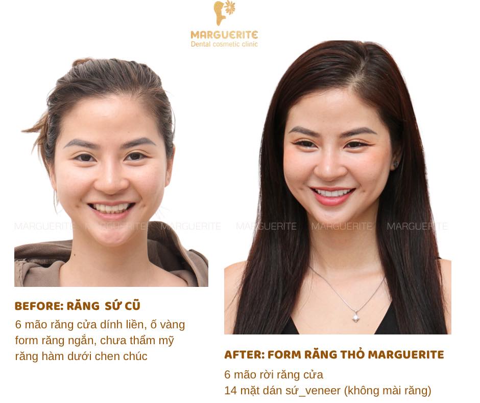 Dán sứ Veneer tại nha khoa Marguerite