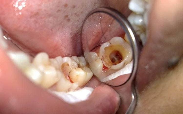 Điều trị tủy răng tại nha khoa Marguerite