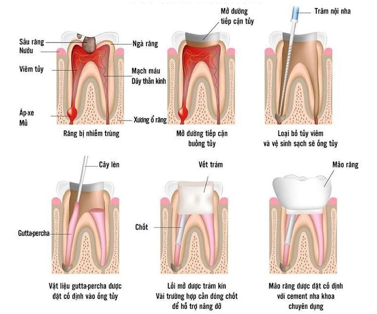 Quy trình điều trị tủy răng an toàn, không đau, hiệu quả tại nha khoa Marguerite